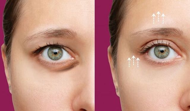 GÖZ KAPAĞI ESTETİĞİNE DAİR MERAK EDİLENLER "Güzel Gör Güzel Görün"