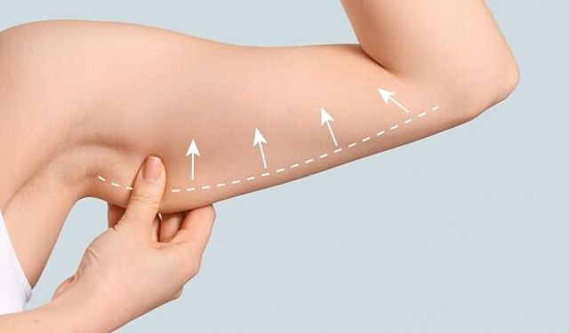 "Obezite cerrahisinden sonra cilt germe operasyonları"